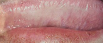Рис. 6. Волосистая лейкоплакия на боковой поверхности языка.
