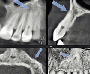 Рис. 7. КТ, визуализация зуба 23, MPR; травма три года назад, облитерация средней и апикальной трети корня.