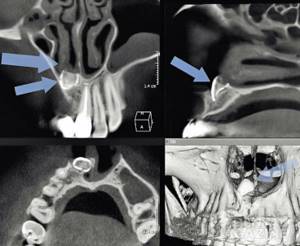 Рис. 8. КТ-визуализация коронковой части зуба 11 в состоянии интрузии, взрослый пациент, в анамнезе травма молочного резца в детстве.