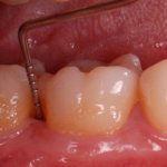 Risks and benefits of probing around teeth and dental implants