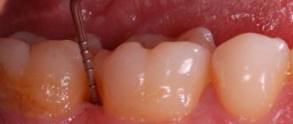 Риски и преимущества зондирования вокруг зубов и дентальных имплантатов