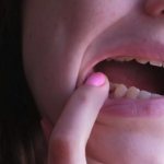 Розовые зубы нужно перелечивать