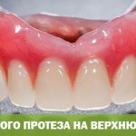 Съемные протезы на верхнюю челюсть без неба