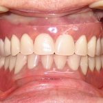 removable dentures