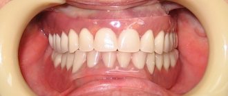 removable dentures