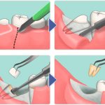 схема удаления зуба мудрости