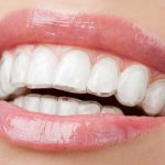 силиконовые брекеты