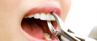 how many teeth can be removed at one time