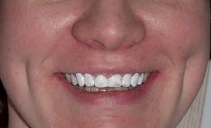 Сложность равномерного нанесения лака для зубов