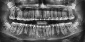 Снимок зубов с брекетами