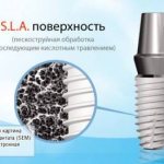 Snucone имплантаты каталог