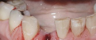 Состояние десны после удаления зуба.jpg