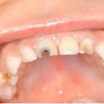 Современные методы восстановления разрушенных молочных передних зубов у детей