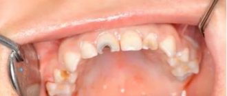 Современные методы восстановления разрушенных молочных передних зубов у детей