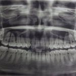 Способы диагностики дистопии зубов