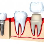 Comparison of benefits