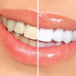 Средства для отбеливания зубов в аптеке