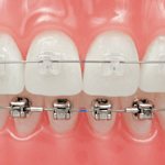 Сроки лечения комбинированными брекетами