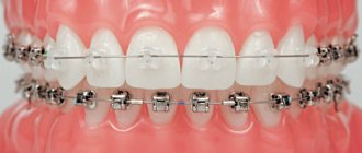 Duration of treatment with combined braces