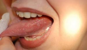 стадии рака языка фото рак языка начальная стадия