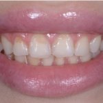 Стираемость эмали зубов