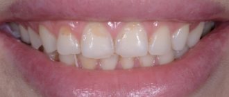 Стираемость эмали зубов