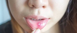 Stomatitis on the inside of the lip