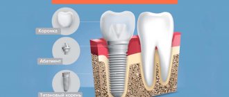 The structure of a dental implant in pictures