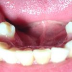 Сверхкомплектные зубы нижней челюсти