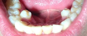 Сверхкомплектные зубы нижней челюсти