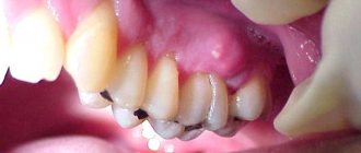 fistula