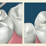 Свойства стеклоиономерного цемента для пломбирования зубов