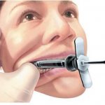 техника проведения торусальной анестезии