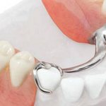 Manufacturing technology of the clasp prosthesis and the material used