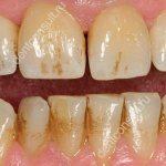 темные зубы