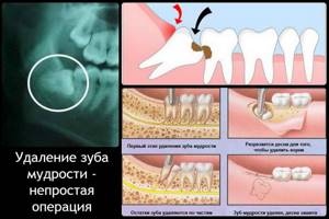 Типичное удаление зуба