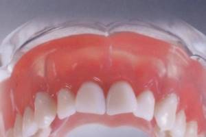 типы фиксации зубных протезов