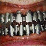 Титановые коронки фото