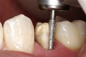 Титановые коронки на зубы цена