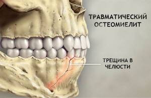 X-ray diagnosis of odontogenic osteomyelitis of the jaws in persons ...