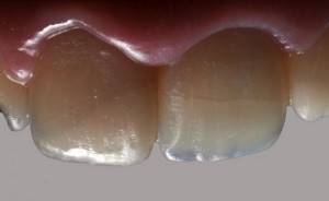 Трещины эмали зуба