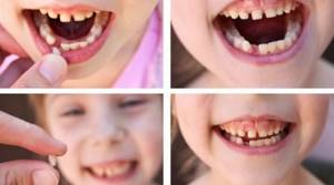 Третья причина кривых зубов и нарушений прикуса - потеря молочных зубов в раннем детстве