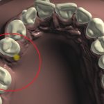 У пациента прозвучал вопрос на предмет отсутствующего зуба на верхней челюсти с правой стороны, зуб номер 5 отсутствует достаточно давно. Хочет поставить имплантат с коронкой