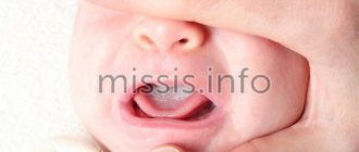 The child has a white coating on the tongue