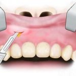Удаление зуба при воспалении
