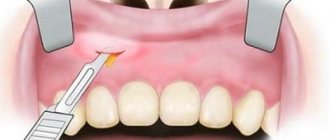 Удаление зуба при воспалении