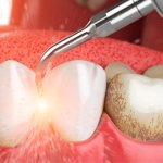 ultrasound or air flow which is better photo