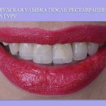 Улыбка после художественной реставрации в Дентал-Гуру
