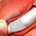 Установка имплантатов без костной пластики