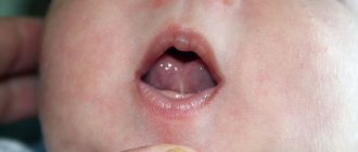 Tongue frenulum - Network of clinics JSC Family Doctor (Moscow) - Photo 1